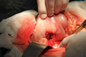 Perforarea ulcerului la stomac este posibil să moară