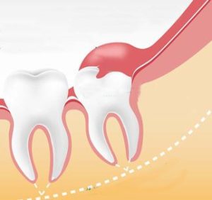 Перікоронаріт зуба мудрості - симптоми, причини, лікування - доктор зуб