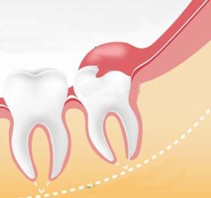 Pericoronarita dintelui de înțelepciune - simptome, cauze, tratament - dinte medic
