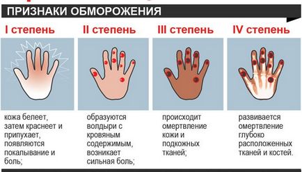 Перша допомога при обмороженні що робити при переохолодженні та відмороженні, окейдок