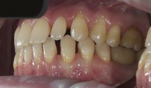 Чому у людей буває більше 200 зубів хвороба поліодонтія