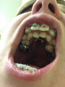 Miért ember van több mint 200 fogak hyperodontia betegség