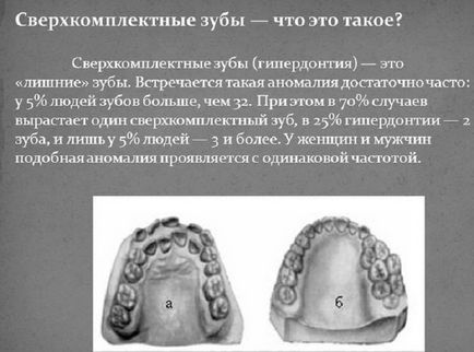 Polyodontia (exces dinții excesivi) cu fotografii, îndepărtarea și tratamentul