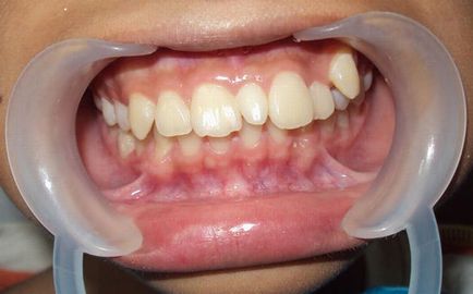 Поліодонтія (надкомплектні зайві зуби) симптоми з фото, видалення і лікування
