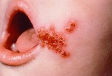 Cauzele alergiilor la copii