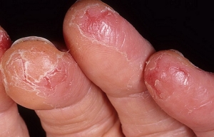Simptomele eczemelor pe mâini