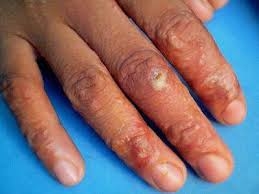 Simptomele eczemelor pe mâini