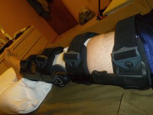 Stretch al simptomelor și tratamentului ligamentului genunchiului