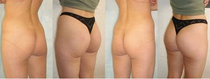 Reabilitarea după gluteoplastie (plastica feselor) - recenzii după recuperare, foto