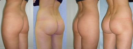 Reabilitarea după gluteoplastie (plastica feselor) - recenzii după recuperare, foto