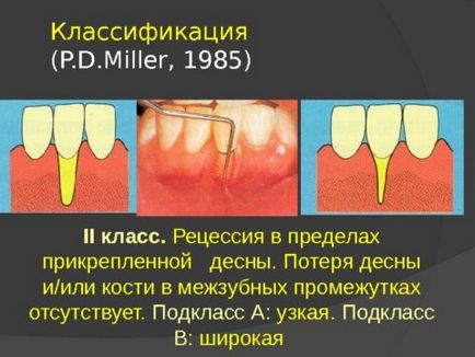 Recesiunea gingiilor provoacă probleme estetice și esența bolii