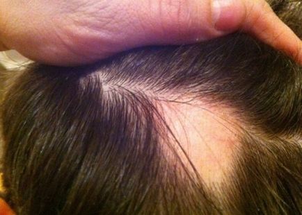 Scopul alopeciei, descrierea, tratamentul