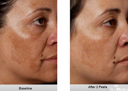 Саліциловий пілінг для обличчя відгуки, фото до і після, рецепти