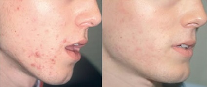 Саліциловий пілінг для обличчя відгуки, фото до і після, рецепти