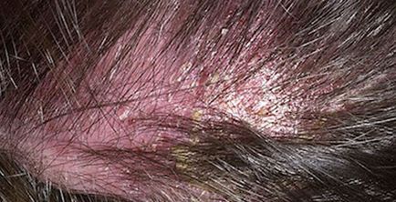 Seborrhoeás dermatitis a fejbőr kezelés, fotók