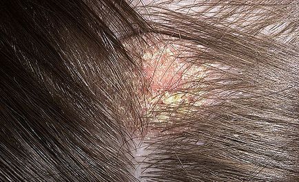 Dermatită seboreică asupra scalpului, tratament, fotografie
