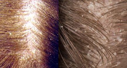 Dermatită seboreică asupra scalpului, tratament, fotografie