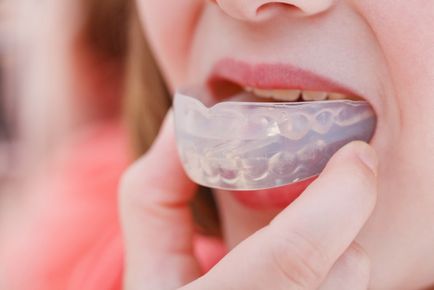 Cserélhető merevítők mítosz vagy valóság a modern fogászat (korrekció malocclusion) Cserélhető merevítők mítosz vagy valóság a modern fogászat