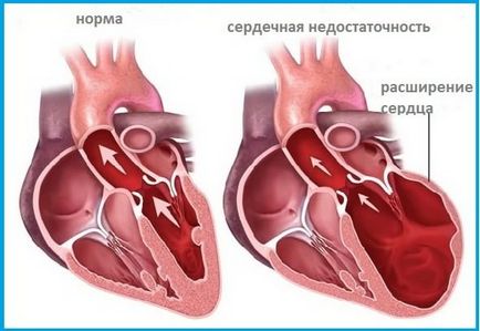 Simptome de insuficiență cardiacă și tratament