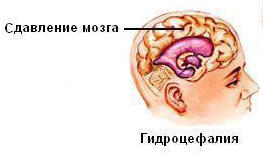 шунтування голови