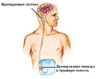 шунтування голови