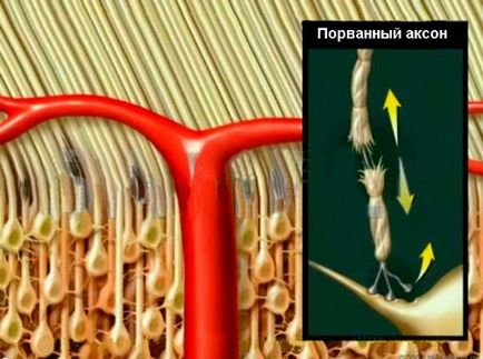 Simptomele afectării cerebrale axonale difuze