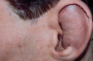 Симптоми грибка вуха - ознаки отомікоза і мікозу у людей