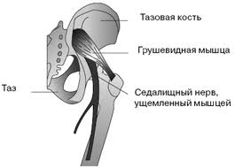 Симптоми і лікувальна гімнастика при синдромі грушоподібної м'язи