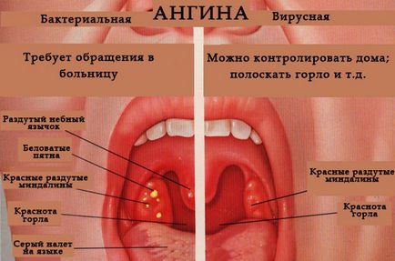 Симптоми і лікування ангіни у дорослих і дітей гнійної, катаральної, герпесного