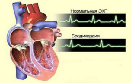 Tahicardia sinusală cauzează, simptome, diagnostic, tratament și prevenire