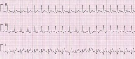 Tahicardia sinusală cauzează, simptome, diagnostic, tratament și prevenire