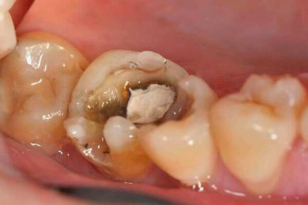 Cât de mult puteți menține arsenul din dinți la un adult - calendarul, acțiunea și contraindicațiile