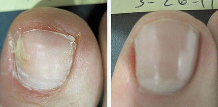 Sfaturi privind modul de vindecare a unei ciuperci de picior și unghii timp de o lună