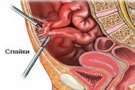 Boala adezivă a cavității abdominale - manifestări și terapie