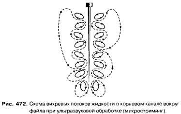 Засоби для медикаментозної обробки (промивання) кореневих каналів