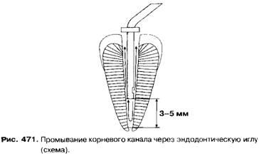 Засоби для медикаментозної обробки (промивання) кореневих каналів