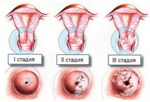 Grade de displazie cervicală