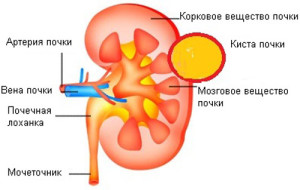 Чи варто боятися появи атипової кісти нирки проблема і її рішення