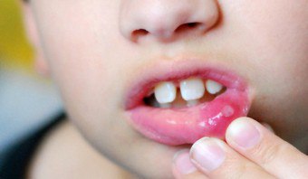 Stomatitis gyermekeknél okoz, tünetei és kezelése