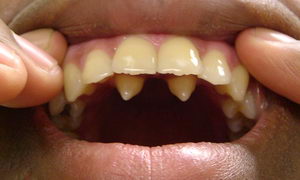 Надкомплектні зуби - більше не завжди краще! Про виправлення прикусу і брекети