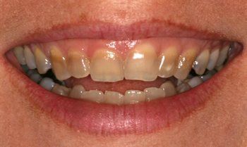 Dinții tetradiclinici nu pot fi nimeni cum să trateze leziunile smalțului cauzate de administrarea unui antibiotic