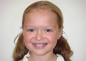 Топ найчастіших питань дитячого стоматолога і ортодонта