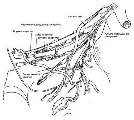 Eliminarea reperelor anatomice ale ganglionilor limfatici pelvieni