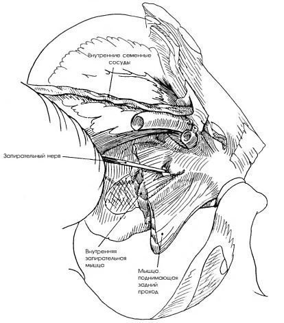 Eliminarea reperelor anatomice ale ganglionilor limfatici pelvieni