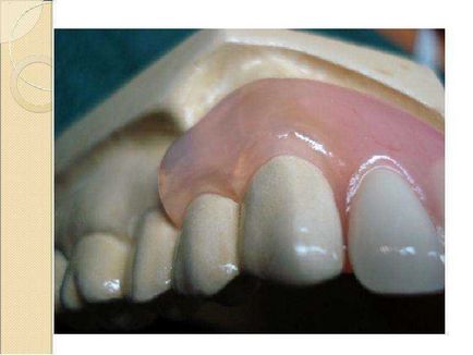 Урок по темі гнучкі нейлонові зубні протези