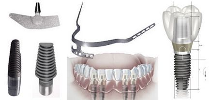 Fogászati ​​implantátum, fogászati ​​óra Moszkva