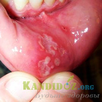 A zsigeri candidiasis (rendszer) (gombák Candida nemzetségbe tartozó) A zsigeri candidiasis (rendszer)