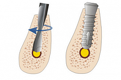 Implantarea intrauterină