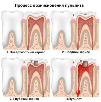 Inflamația simptomelor și tratamentului nervului dentar