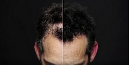 Ideiglenes szőr „spray, amely elfedi a kopasz vagy rossz hajvágás